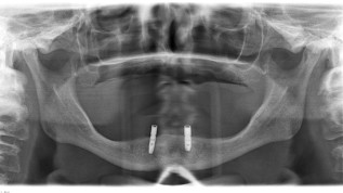 XY ungelöst: Probleme mit ­Attachments für implantat- getragene Deckprothesen