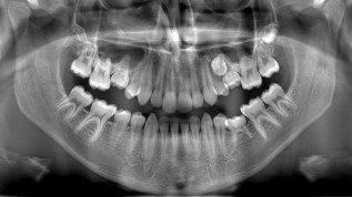 Indikationen kieferorthopädischer Behandlungen