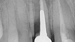 Augmentation eines Schaltlückendefekts durch Tent Pole-Technik