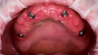  Vom Prototypen zur definitiven Full-Arch-Brücke auf vier Implantaten