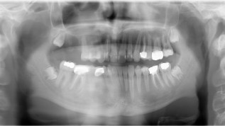 Zahntransplantation und 3-D-Planung