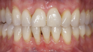 Grenzen minimalinvasiver Veneers