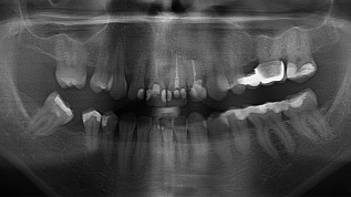 Optimale Ästhetik mit Keramikimplantaten