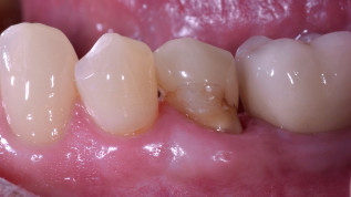 Vereinfachter Workflow bei der postendodontischen Versorgung