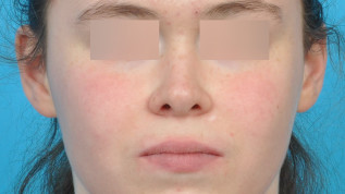 Aesthetics Follows Function – Extraktionstherapie auch aus ästhetischer Sicht?