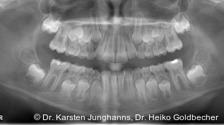 Gesteuerte Extraktion und kieferorthopädischer Lückenschluss – eine Behandlungsoption bei MIH