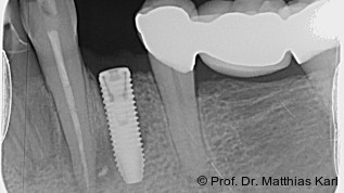 Primäre Implantatstabilität – ist mehr immer besser?