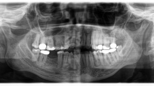 Implantattherapie beim Vorliegen einer zemento-ossären Dysplasie