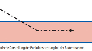 Dos and Don’ts in der Herstellung und Prozessierung des PRF