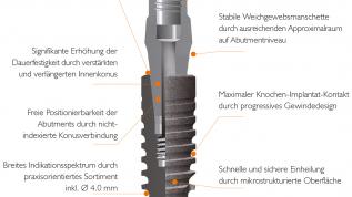 Erfolgreiches Implantatkonzept neu ausgerichtet