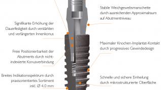 Neue Wege zur modernen Implantattherapie