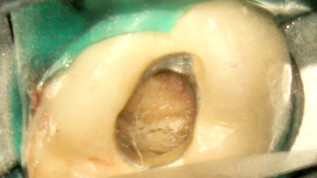 Perforation des Pulpabodens eines Brückenpfeilerzahns