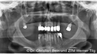 Gaumenfreie Hybridversorgung mit Implantaten