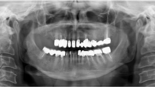 Stressfreie Sofortversorgung von Implantaten im Teamwork