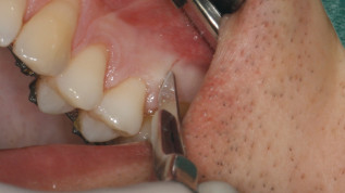Beschleunigte orthodontische Zahnbewegung: Was funktioniert heutzutage wirklich?