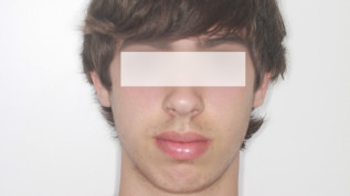 Therapie von Engstand und Protrusion mithilfe nicht alltäglicher Extraktionen