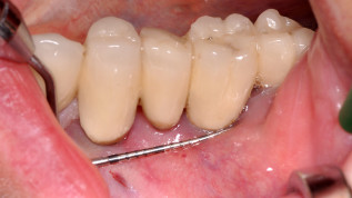 Chirurgische Periimplantitistherapie von Implantatoberflächen