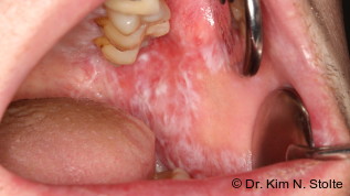 Oraler Lichen planus