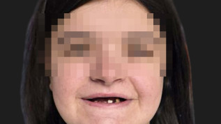 Cleidokraniale Dysplasie als interdisziplinäre Herausforderung der Kieferorthopädie