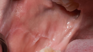 Chronische Trockenheit, chronische Leiden? Das Sjögren-Syndrom im Fokus