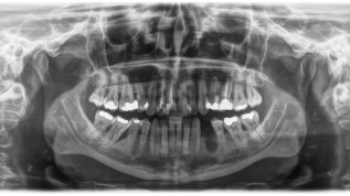 Kieferkammaugmentation mithilfe eines allogenen Knochenrings