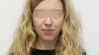 Behandlung eines frontal offenen Bisses mithilfe von Alignern