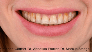 Ästhetische Zahnkorrekturen mit Veneers und Bindegewebstransplantaten