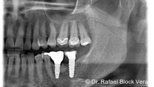 Aktivsauerstoff in der Periimplantitistherapie
