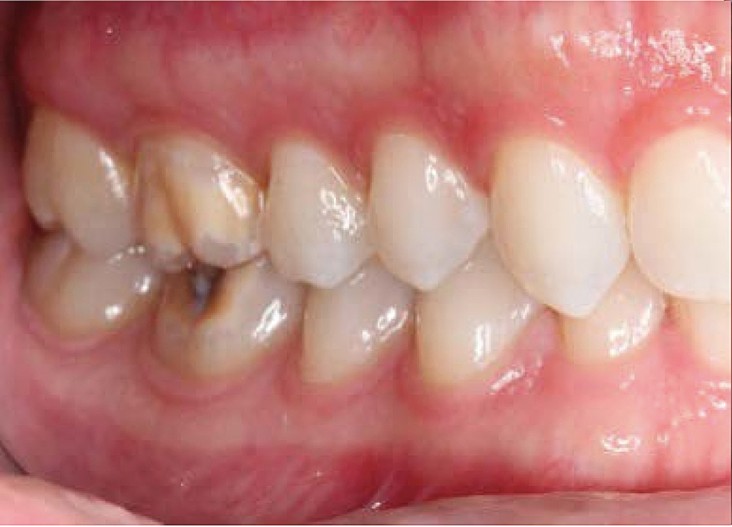 Diagnostik Und Therapeutische Konsequenzen Der Molaren Inzisiven Hypomineralisation Teil 2 Zwp Online Das Nachrichtenportal Fur Die Dentalbranche