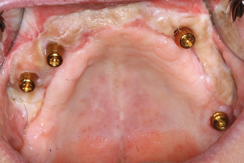 bei extremer Alveolarkammatrophie ZWP online das