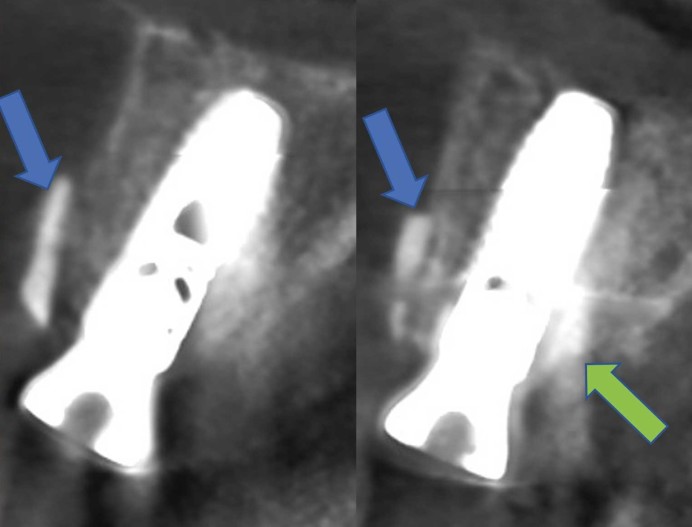Tooth Shell Technique: Ästhetische Kieferkammrekonstruktion – ZWP ...
