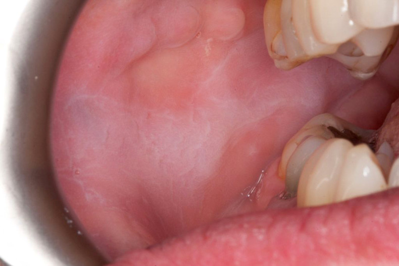 Mund im weißer punkt Mundhöhlenkrebs durch