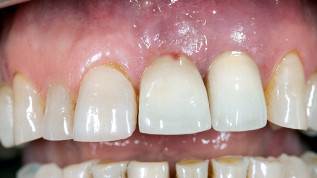 Knochenregenerationsmaterial bei Periimplantitistherapie