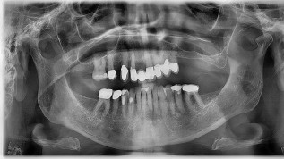 Externer Sinuslift mit simultaner Implantation