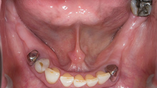 Periimplantäre Weichgewebeverdickung – stabil und funktionell