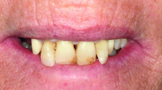 Augmentation mit partikelförmigem Dentin im Oberkiefer