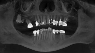 „Floating Implants“  mit Keramikimplantaten