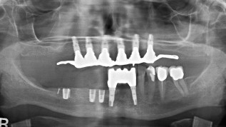 Prothetische Versorgung mit Implantaten