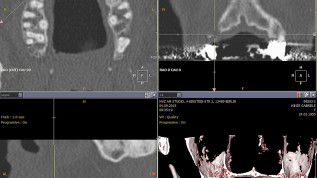 Bone Spreading – erfolgreicher Knochengewinn