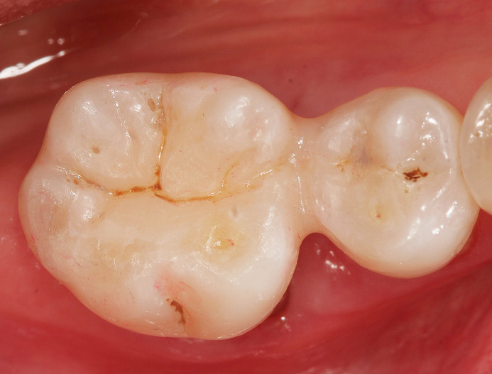 Schienungen im parodontal kompromittierten Gebiss – ZWP online – das  Nachrichtenportal für die Dentalbranche