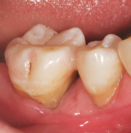 Schienungen im parodontal kompromittierten Gebiss – ZWP online – das  Nachrichtenportal für die Dentalbranche
