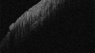 Therapieoptionen bei Pharyngitiden &ndash; ein Update