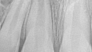 Regenerative Endodontie am unreifen permanenten Inzisivus