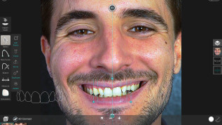 Veneers – Ein Plädoyer für die Handarbeit