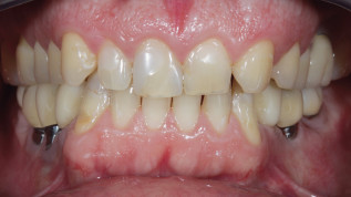 Fallbericht: Adhäsive Full-Mouth-Rehabilitation