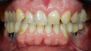 Adhäsive Full-Mouth-Rehabilitation: Modern und substanzschonend