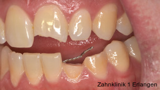 Pulpadiagnostik und -therapie nach Zahntrauma