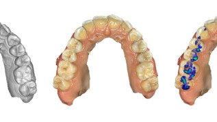 Erste S2k-Leitlinie zum Intraoralscan