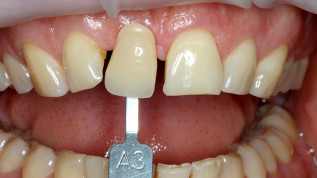 Implantatfraktur bei Sofortversorgung