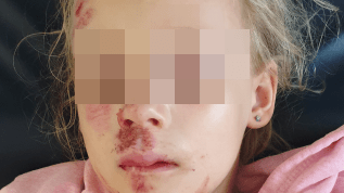 Die Therapie von Frontzahntraumata Teil 1: Zahnfrakturen